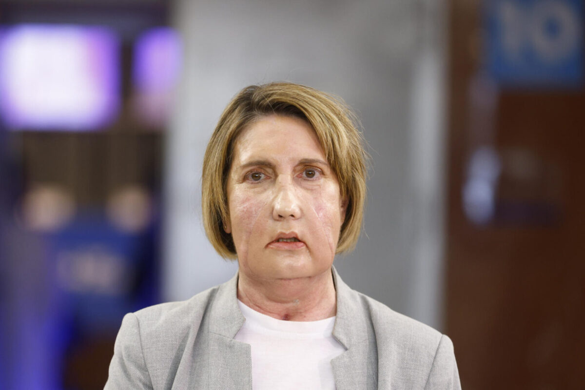 Carme, la primera paciente en recibir un trasplante de cara de una donante que recibió una eutanasia