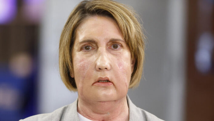 Carme, la primera paciente en recibir un trasplante de cara de una donante que recibió una eutanasia