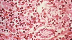 Imagen del síndrome pulmonar causado por el hantavirus